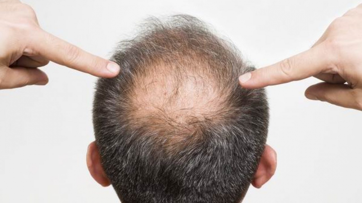 弗若斯特沙利文預計中國的毛髮醫療服務市場,到2030年將達到1381億元