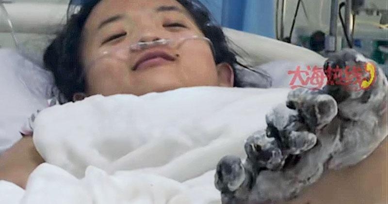 少女内臟損傷嚴重,身上多處變焦黑,10跟腳趾頭成碳,面臨截肢。