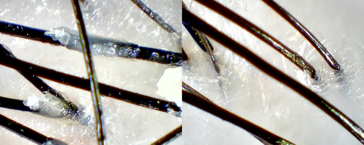 左:以洗頭水清潔後,毛囊內尚有很多油脂和老廢角質;右:深層清潔後